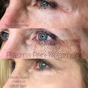 Under Eyes Fibroblasting