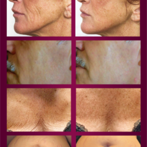 Fibroblasting Abdomen Stretch Marks