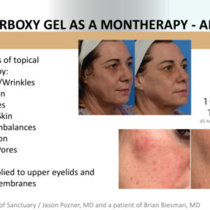 CO2 Lift Pro Dermablading Facial