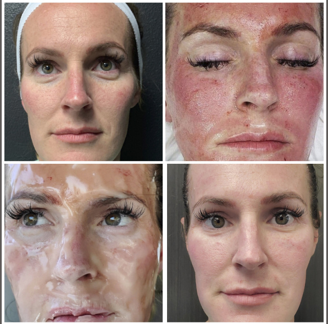 CO2 Lift Pro MicroChanneling Facial