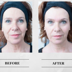 MicroDermabrasion Upgrade – Add to Any Facial