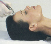 MegaPEEL MicroDermabrasion